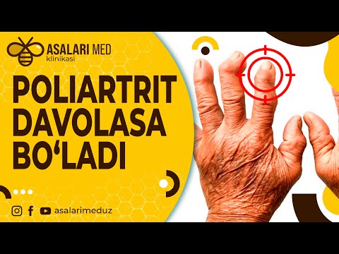 Видео: Полиартритнинг 100 %табиий ва ишончли давоси. #asalarimed  #poliartrit  #artrit