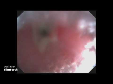 Видео: Рубцовый стеноз пищевода. (Последствия ожога уксусом)