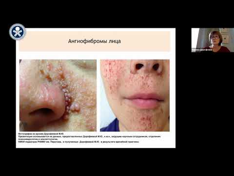 Видео: Туберозный склероз. Диагностика и лечение. Дорофеева М.Ю.