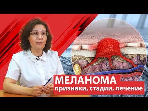 Видео: Меланома ( рак кожи ) . Признаки, стадии, лечение.
