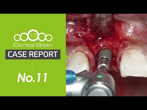 Видео: [Русский]Изменение объема ткани в переднем зубе верхней челюсти с костным трансплантатом или безнего