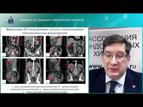 Видео: Вебинар: Эндовидеохирургическая адреналэктомия
