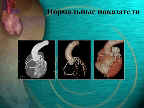 Видео: МСКТ сердца и коронарных артерий.