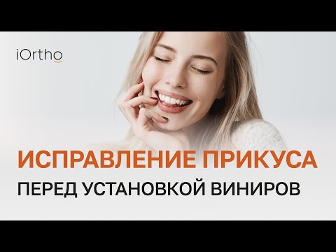 Видео: 🦷​👀 Ортодонтическое лечение перед установкой виниров