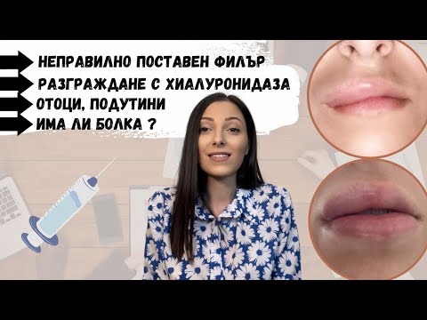 Видео: МОЯТ ОПИТ С ХИАЛУРОНА | ПОСТАВЯНЕ, ПОСЛЕДСТВИЯ, ОТОЦИ, РАЗГРАЖДАНЕ