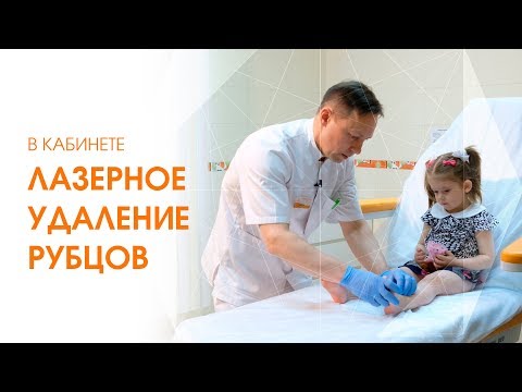 Видео: Удаление рубцов детям. Гипертрофический рубец. Процедура лечения рубцов [Линлайн Сеть клиник]