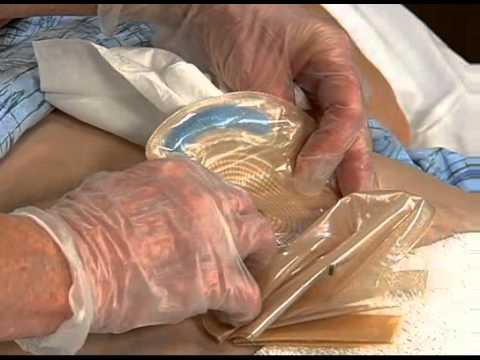 Видео: Уход за колостомой (на русском языке)