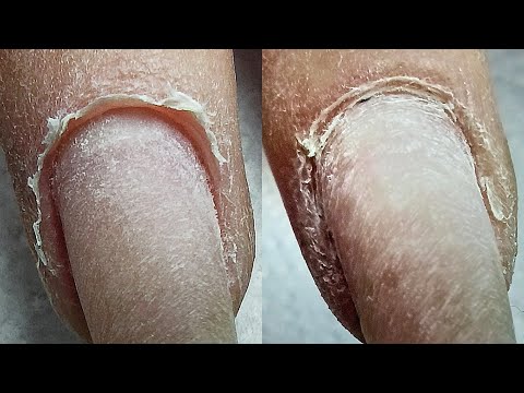 Видео: ЖЕСТЬ! Что делать? ЗАУСЕНЦЫ и ТРЕЩИНЫ на пальцах Мясистая кутикула Виктория Авдеева