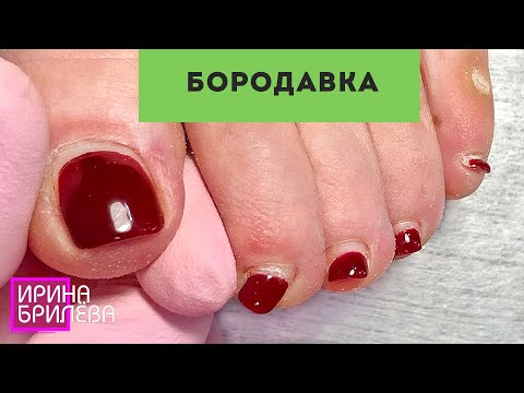 Видео: ПЕДИКЮР 🌸 Избавляемся от БОРОДАВКИ НА СТОПЕ 🌸 Ирина Брилёва