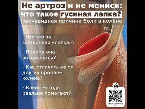 Видео: Не артроз и не мениск: что такое гусиная лапка?