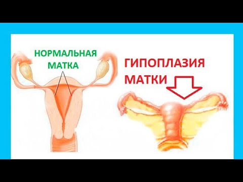 Видео: Гипоплазия матка( детская матка) бесплодия.