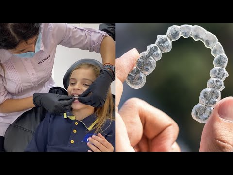 Видео: ПОСТАВЯНЕ НА INVISALIGN