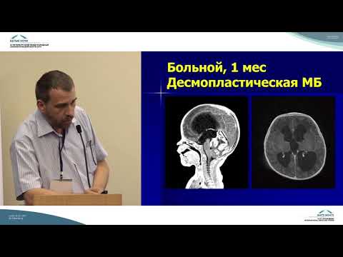 Видео: Нейрохирургические аспекты в детской нейроонкологии