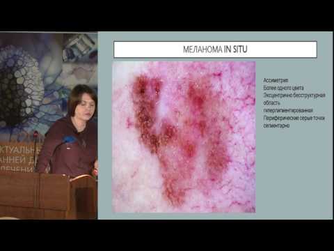 Видео: А.Н. Хлебникова, Дерматоскопия в ранней диагностике меланомы.