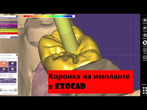 Видео: Цирконий на Импланте в exocad. Моделировка коронки на имплантатах в цифре. Моделирование зубов.