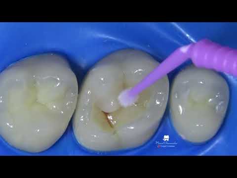Видео: фантомная композитная реставрация верхнего шестого зуба (16 tooth phantom composite restoration)