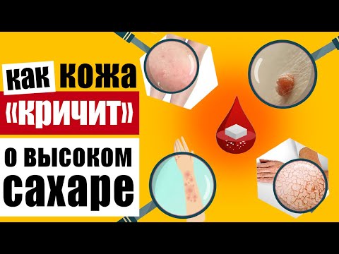 Видео: Предупреждающие признаки на коже, которые говорят о высоком уровне сахара в крови