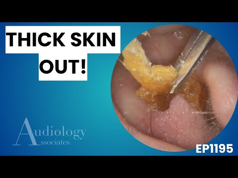 Видео: Экстремальное удаление ушной серы | Утолщение кожи и возможный обтурирующий кератоз - EP1195