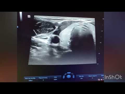 Видео: Измерение щитовидной железы #ultrasound