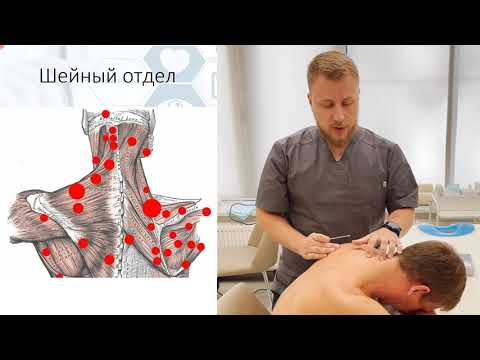 Видео: Боль в шее иглоукалывание