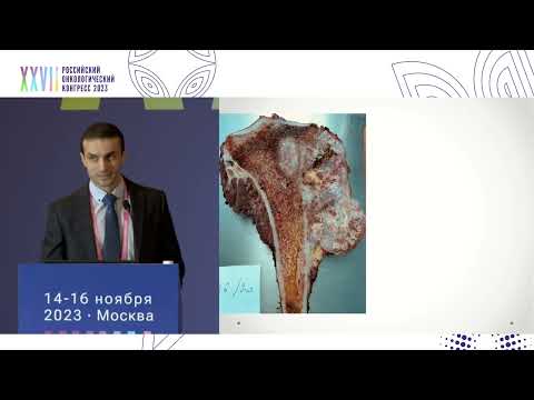 Видео: Биопсия сарком: пункционная или открытая