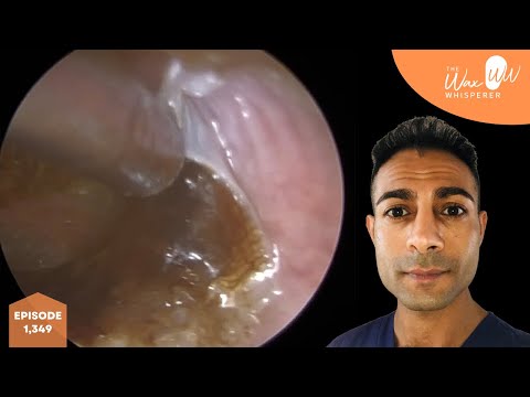 Видео: 1349 - Синдром отслоения омертвевшей инфицированной кожи и зияния верхнего слухового прохода