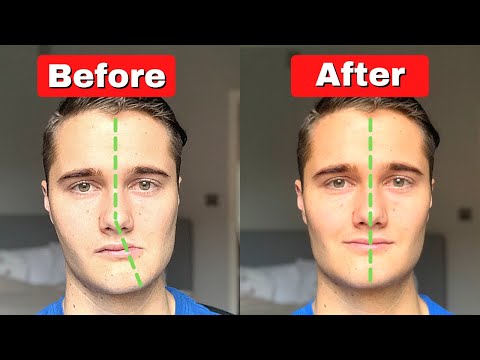 Видео: Как исправить асимметричную челюсть и лицо (СЕГОДНЯ!)