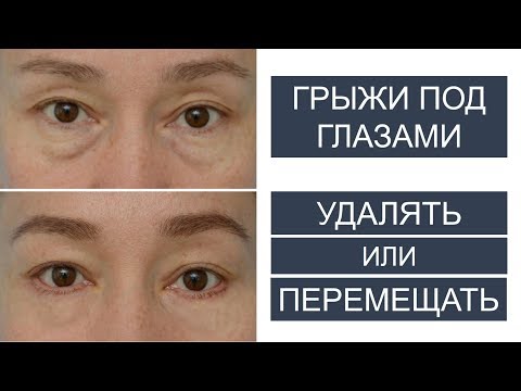 Видео: Грыжи под глазами: УДАЛЯТЬ или ПЕРЕМЕЩАТЬ?