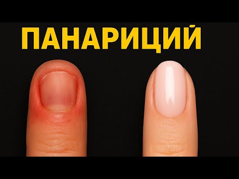 Видео: Необычный случай: Маникюр и Панариций. Ногти-трамплины.