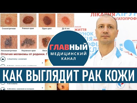 Видео: Как выглядит РАК КОЖИ (фото 1-8). Меланома, базалиома и плоскоклеточный рак кожи