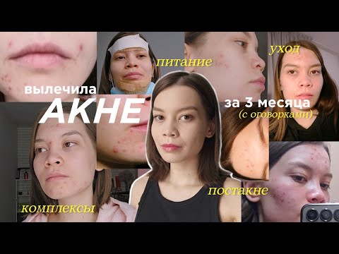 Видео: Я лечила акне 3 месяца, и вот как это было  | Всё об уходе за кожей, диете, комплексах