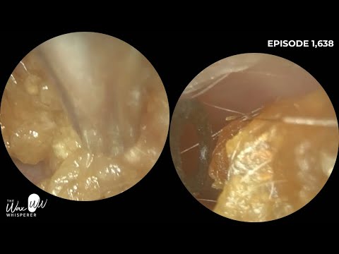 Видео: 1638 — после удаления ушной серы обнаружены большие ямки в ушах