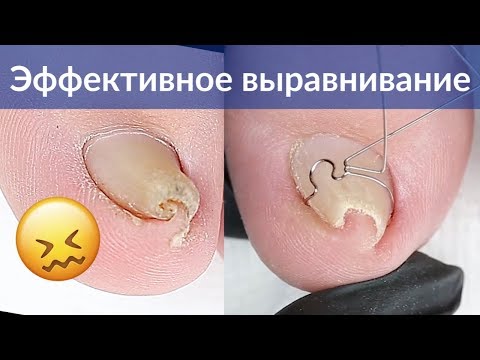 Видео: Как выровнять скрученный ноготь на ногах | Скоба на вросший ноготь | Педикюр