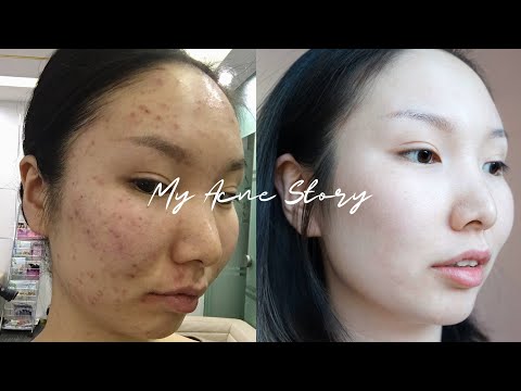 Видео: Би яаж батганаас салсан бэ? || How I cleared my acne