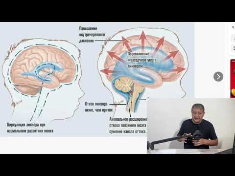 Видео: Черепной давление(мия ичи босими ) ошишига стрессни ахамияти  . Сабаблари, даволаш хакида 1-кисм