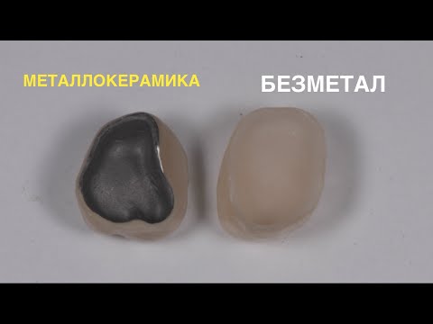 Видео: Металлокерамика или безметалловые коронки?
