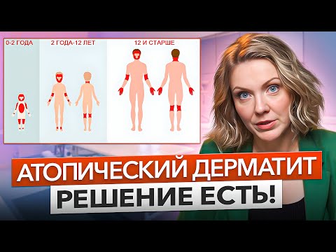 Видео: Атопический дерматит как лечтить. Можно ли вылечить атопический дерматит?