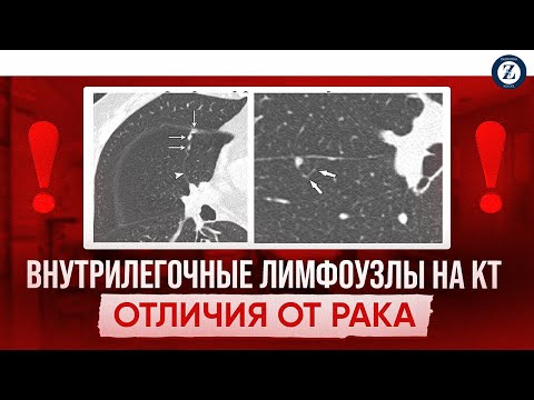 Видео: Внутрилегочные лимфоузлы, критерии доброкачественности, Тихонова Валерия.