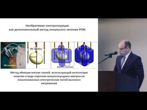Видео: Местно-распространенный рак поджелудочной железы: есть ли место локальному лечению?