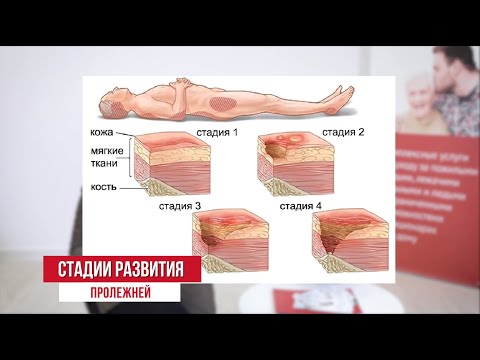 Видео: ПРОФИЛАКТИКА ПРОЛЕЖНЕЙ: ОСНОВЫ УХОДА
