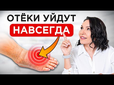 Видео: Как ИЗБАВИТЬСЯ от отеков РАЗ и НАВСЕГДА? / Причины отечности