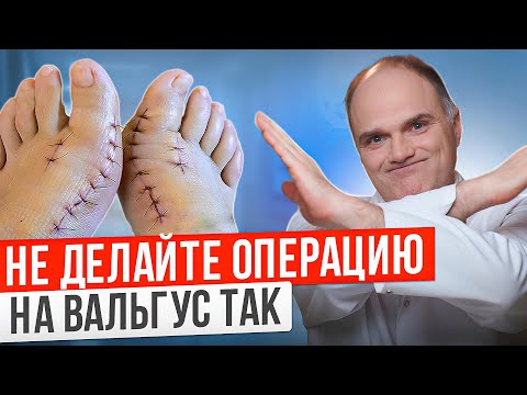 Видео: 3 простых шага чтобы снизить риск рецидива косточки на ноге!