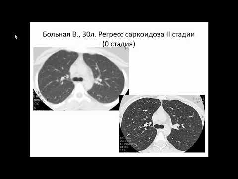 Видео: Сперанская А.А. «Лучевая диагностика прогрессирующего саркоидоза»