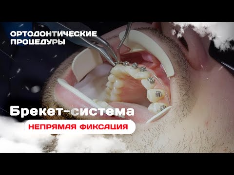 Видео: Непрямая фиксация брекет системы