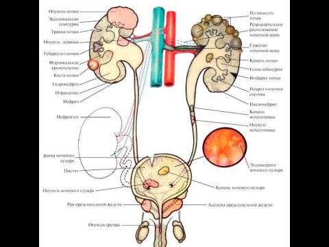 Видео: Кровь в моче. Откуда она взялась и что делать?