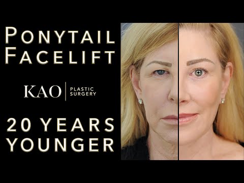 Видео: Подтяжка лица с помощью конского хвоста: видео до и после — подтяжка губ, подтяжка щек KaOgee, по...