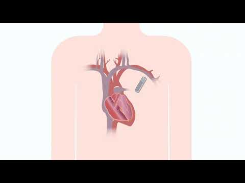 Видео: 05 Кардиологические устройства