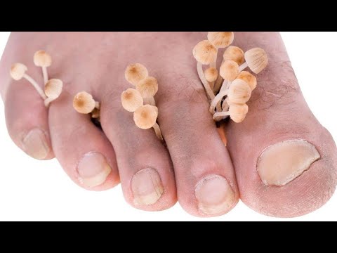 Видео: Микозы (проф. Аравийская Е.А.)