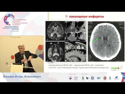 Видео: Мастер класс лечение инсульта Вознюк И.А.