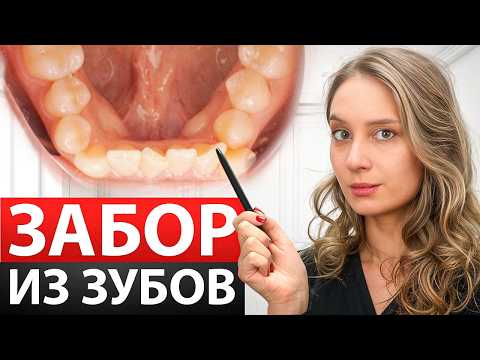 Видео: Исправление прикуса на примере наших кейсов. Скученность, протезирование зубов.